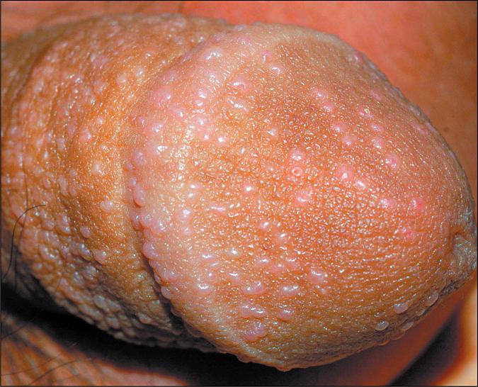 Why do pimples appear on the penis?