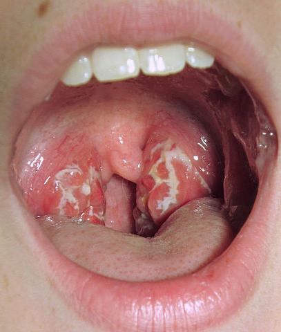 White coating on the adult's tongue: causes and treatment