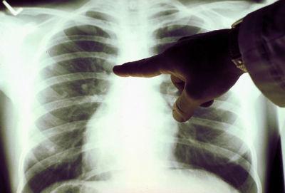 Diagnosis: lung cancer. How much to live?