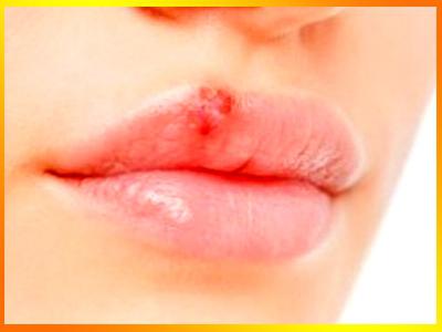 how to treat a cold on the lips
