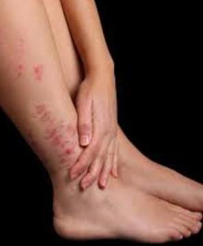 psoriasis causes the onset of treatment