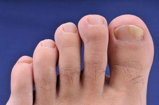 Symptoms of nail fungus on legs, characteristics and varieties